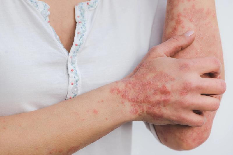 7 Remedies to Help Treat Skin Inflammation